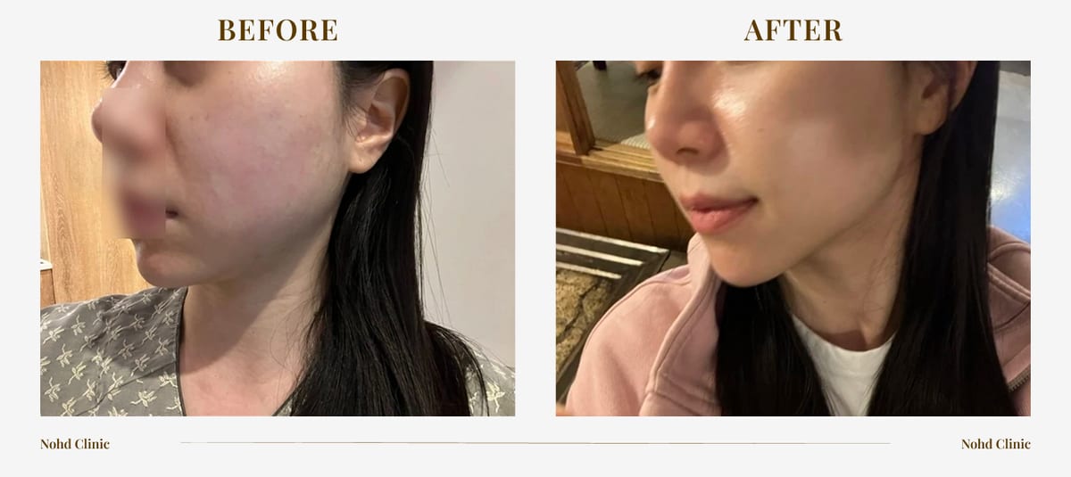 Ultherapy lifting — before and after