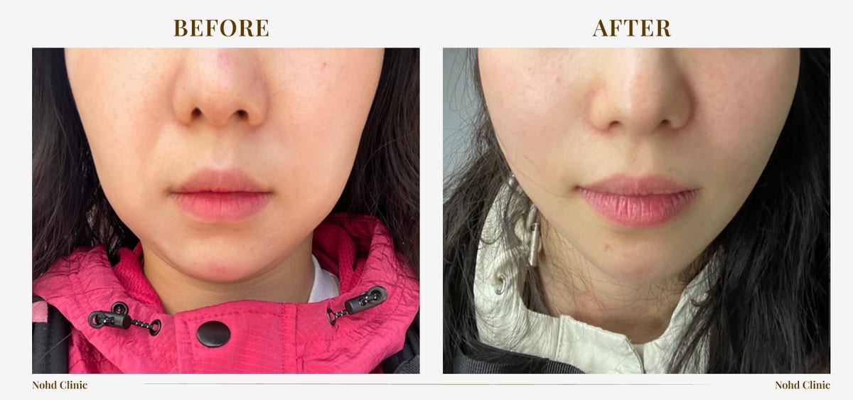 Ultherapy lifting — before and after