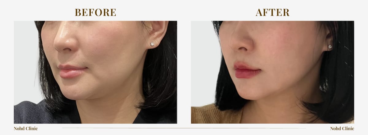 Ultherapy lifting — before and after