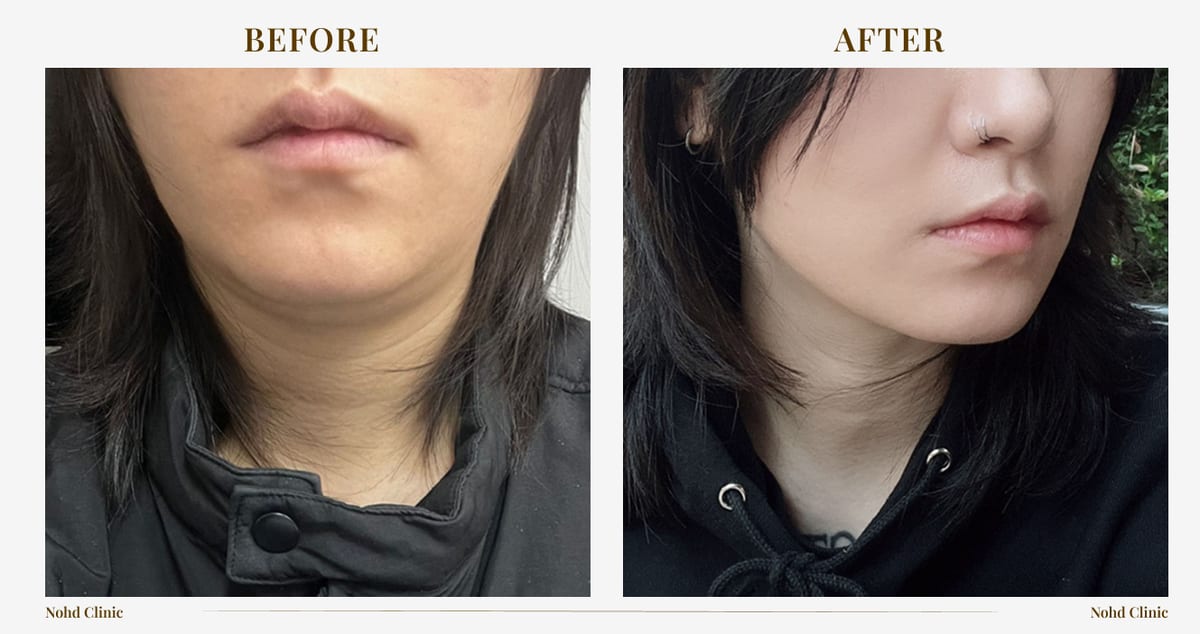 ONDA lifting — before and after