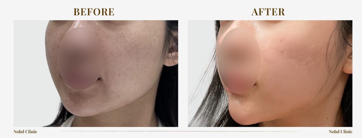 ONDA lifting — before and after