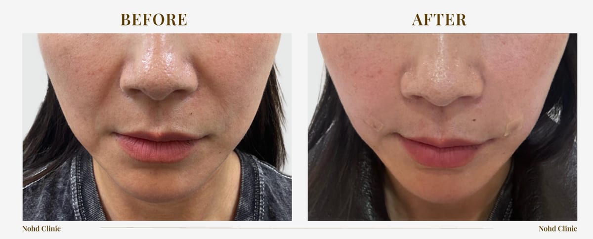Thread lift & filler — before and after