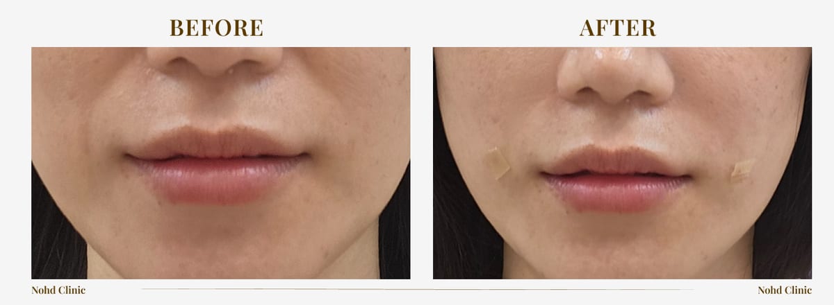 Thread lift & filler — before and after