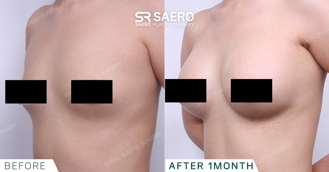 SAERO before and after