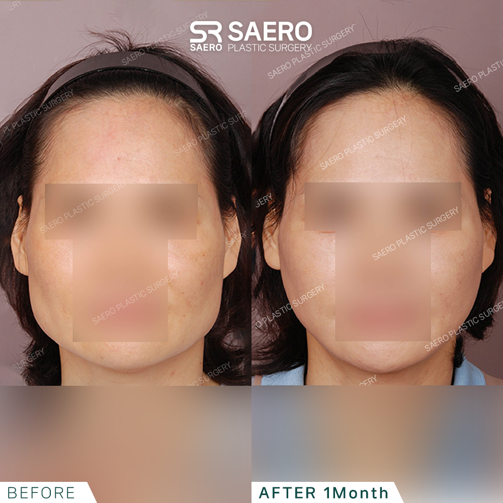 SAERO before and after
