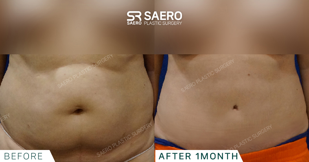 SAERO before and after
