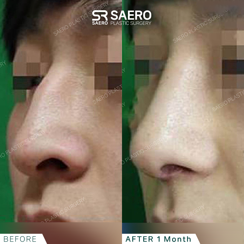 SAERO before and after