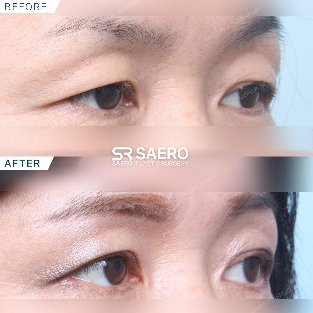SAERO before and after