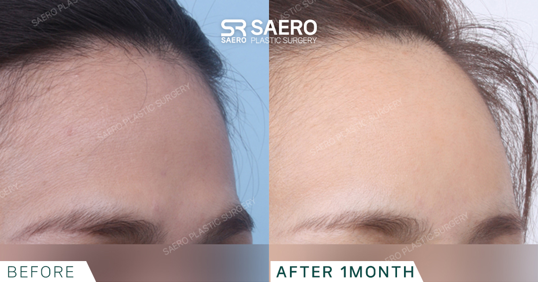 SAERO before and after