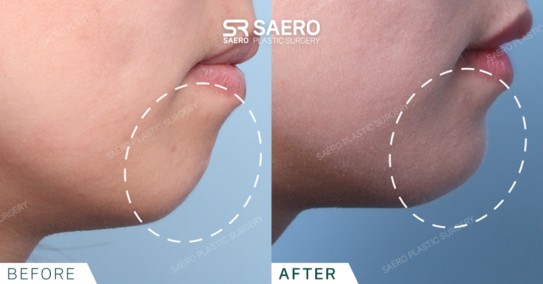 SAERO before and after