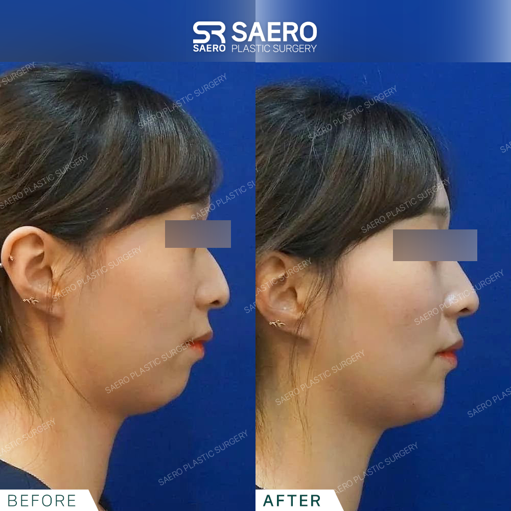 SAERO before and after