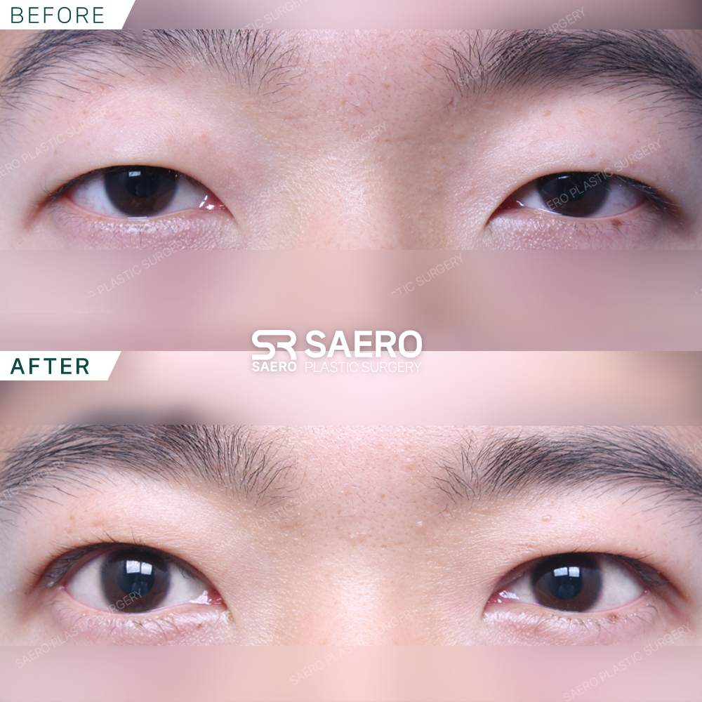 SAERO before and after