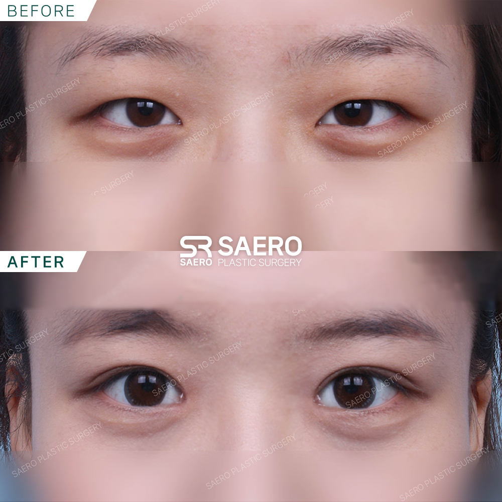 SAERO before and after