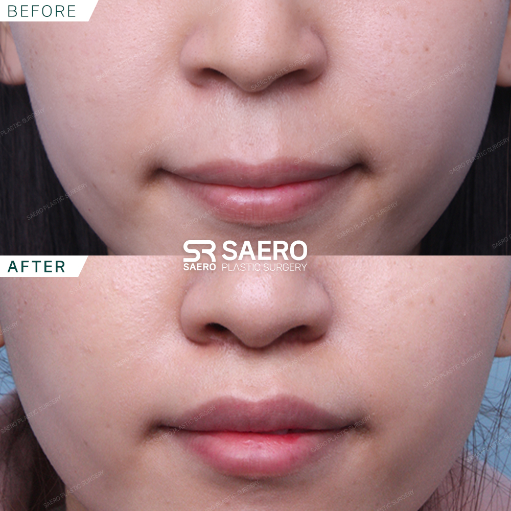 SAERO before and after