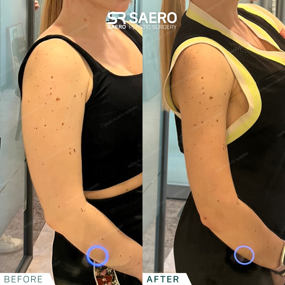 SAERO before and after