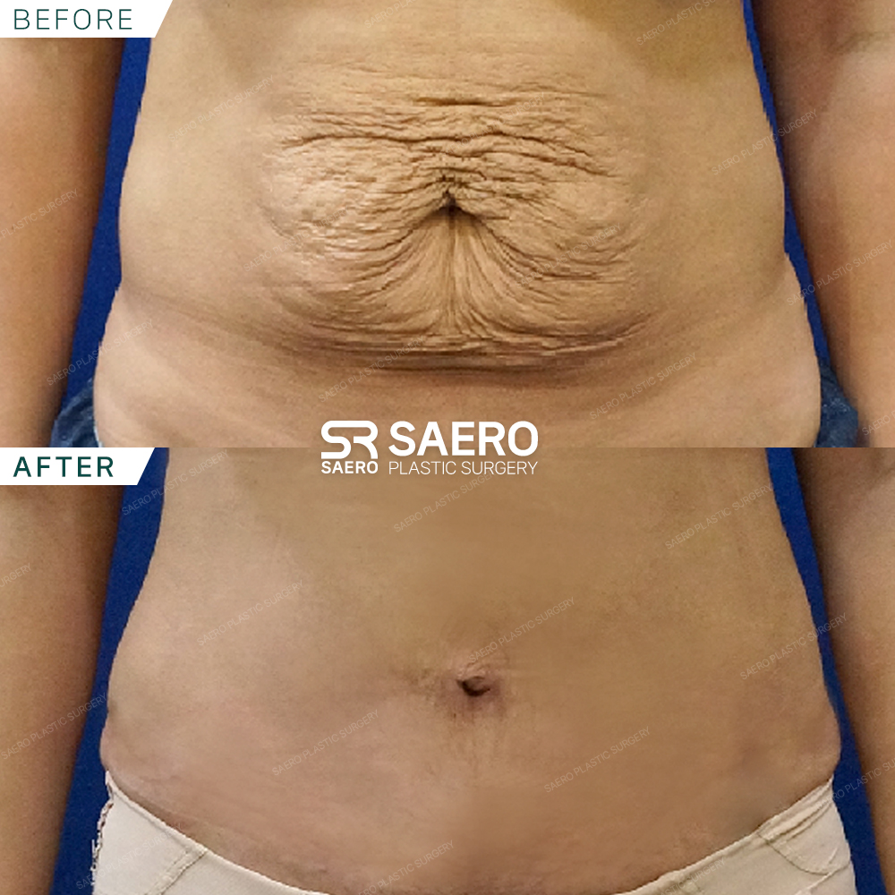 SAERO before and after