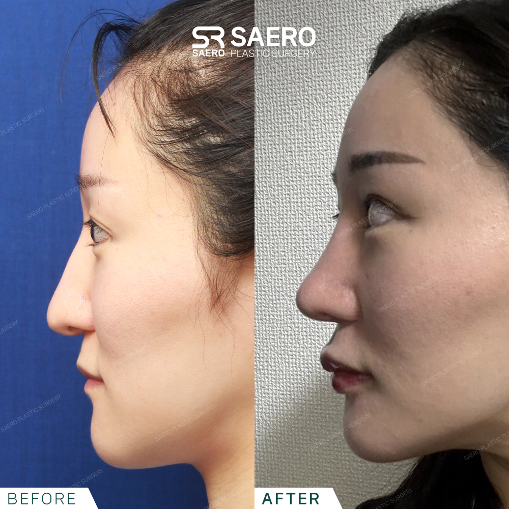 SAERO before and after