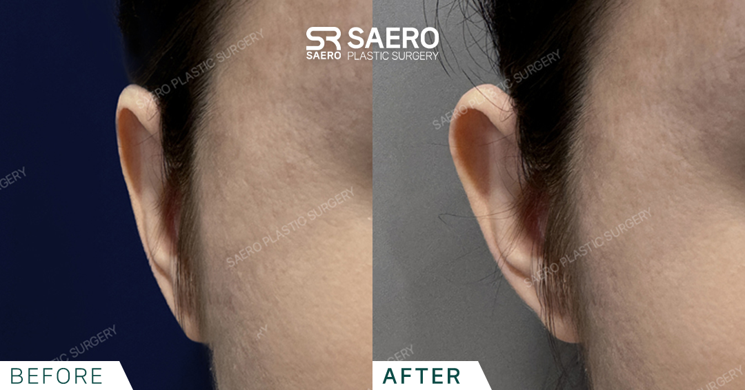SAERO before and after