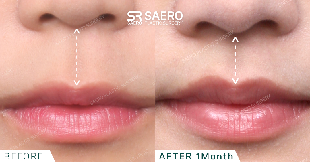 SAERO before and after