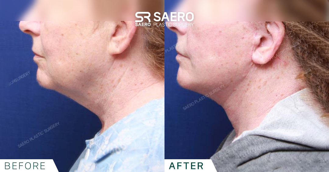 SAERO before and after