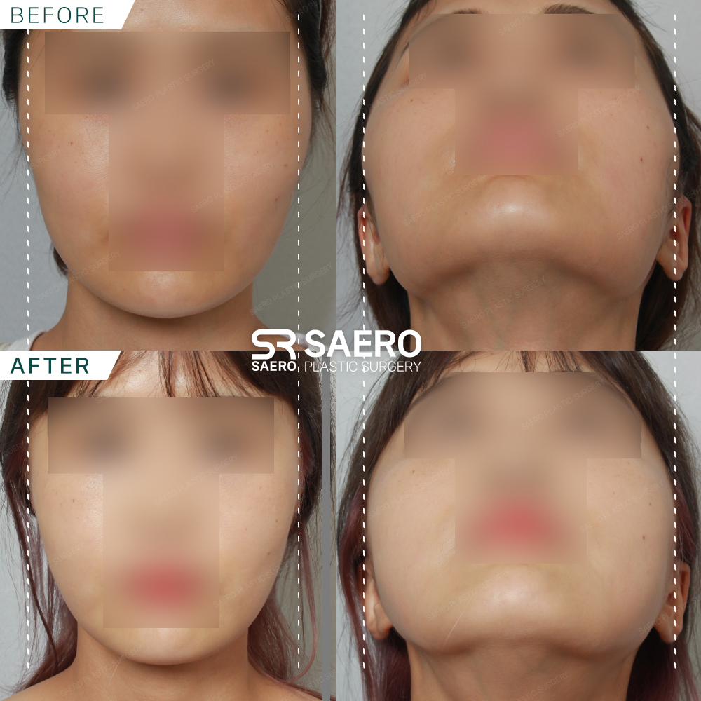 SAERO before and after