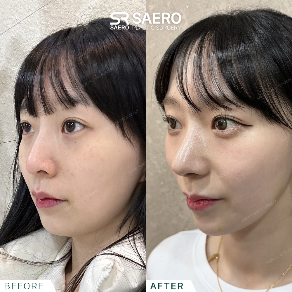 SAERO before and after