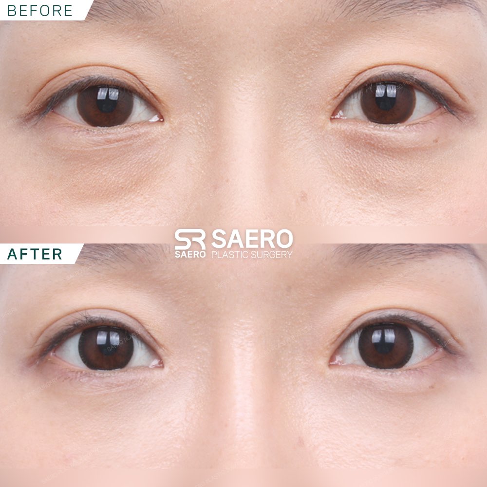 SAERO before and after
