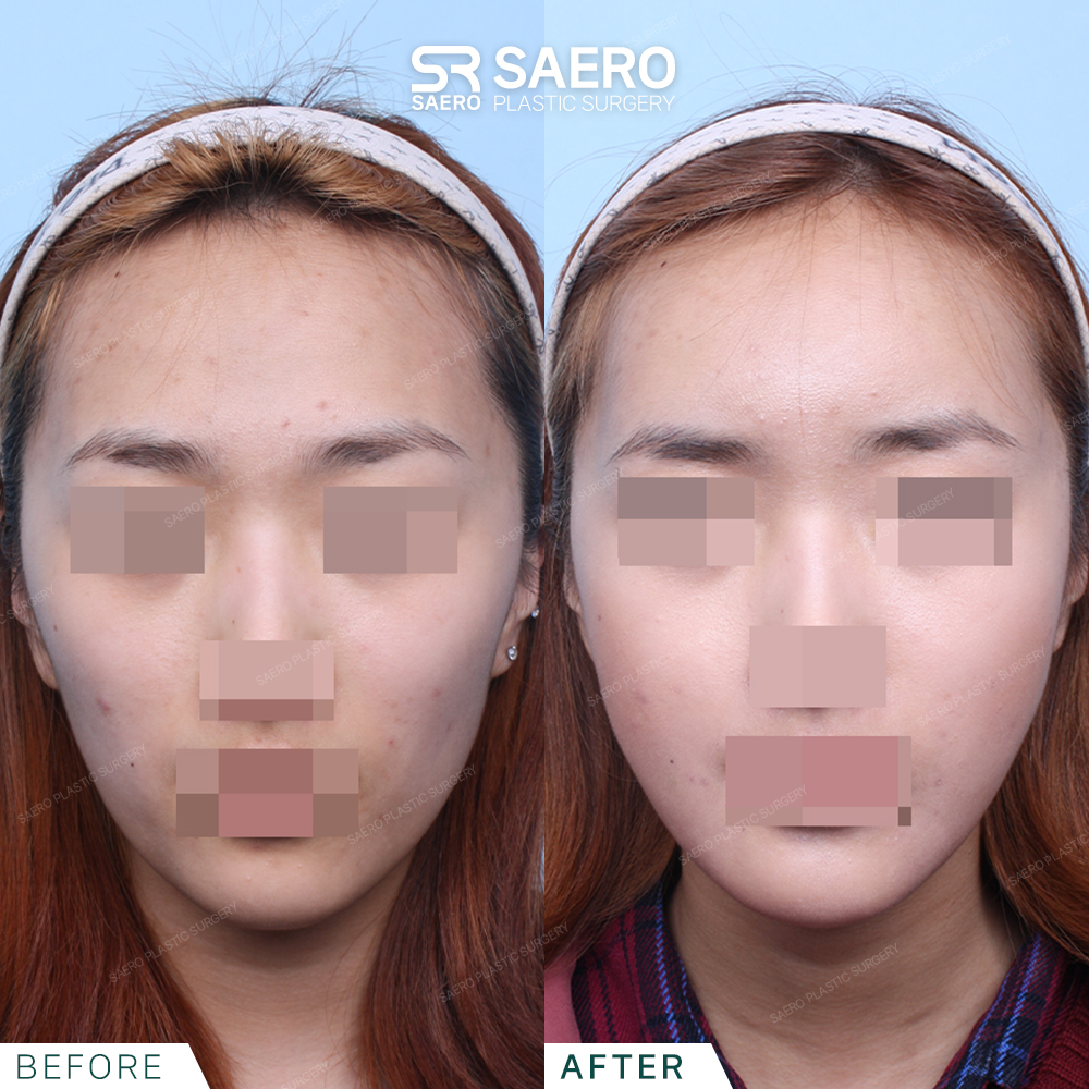 SAERO before and after