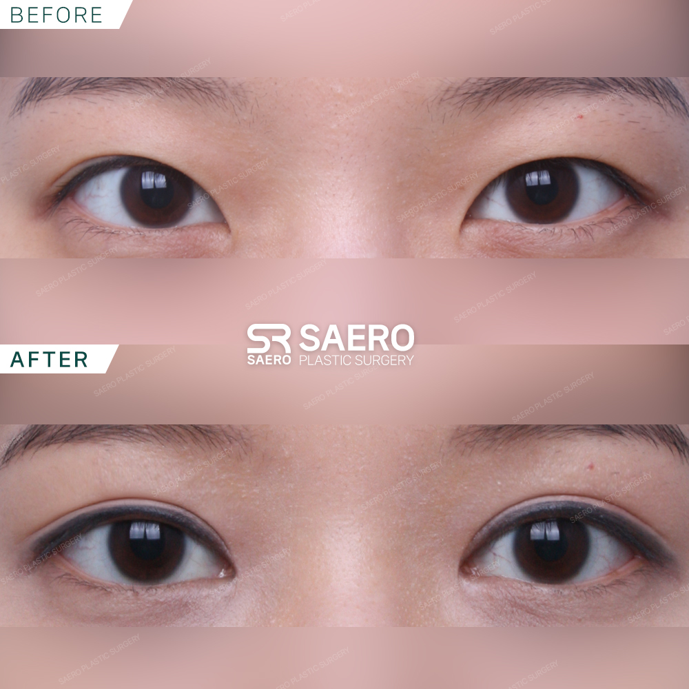 SAERO before and after
