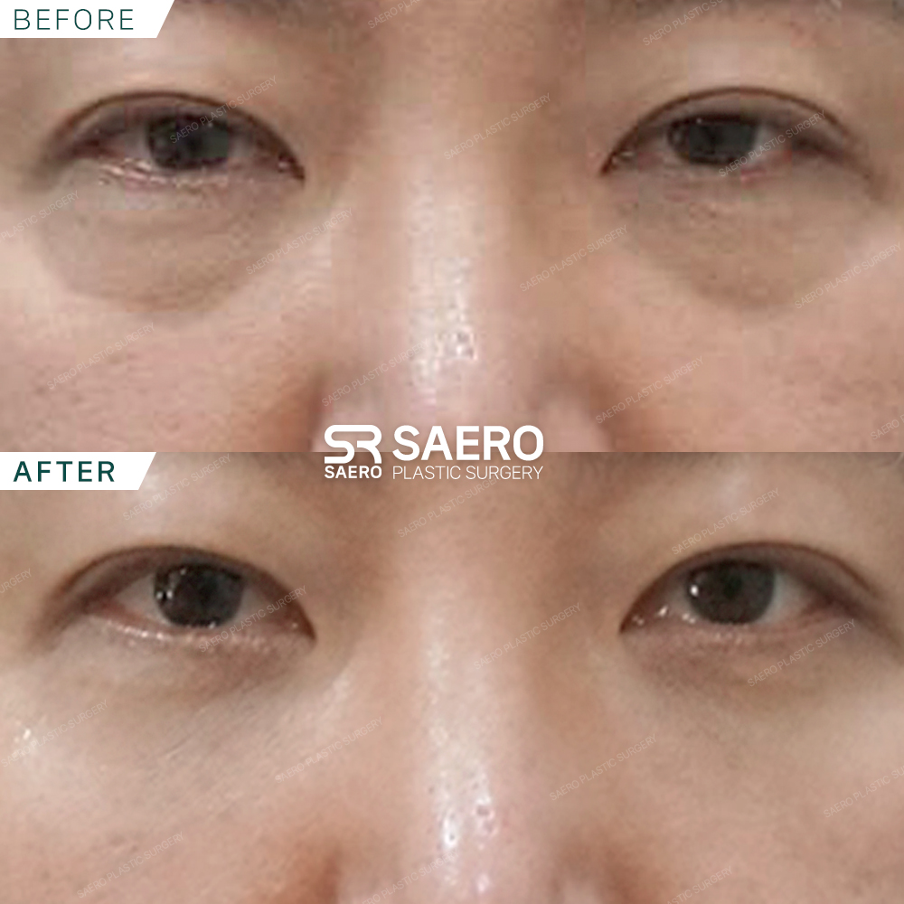 SAERO before and after