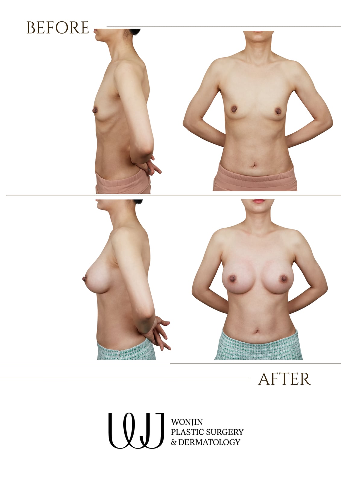 Breast augmentation — before and after