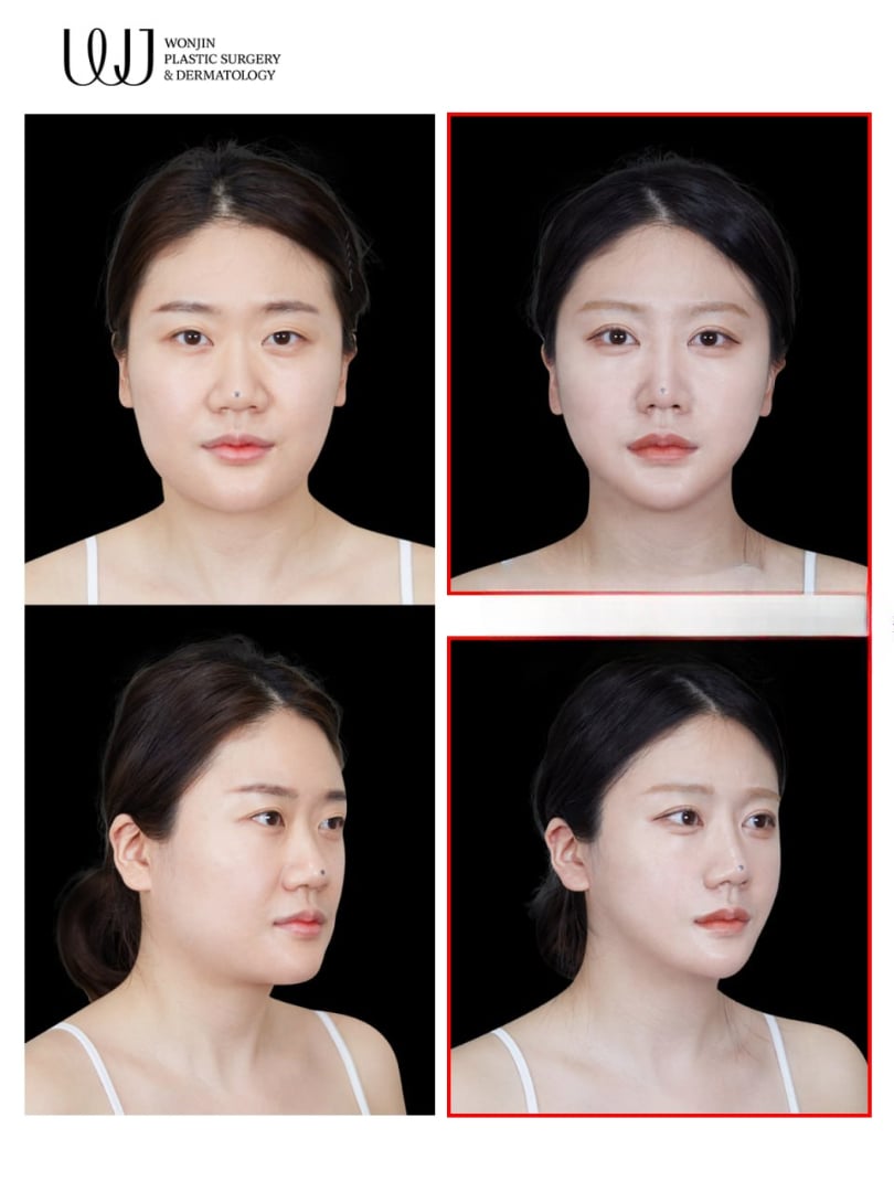 Facial contouring (V-line) — before and after