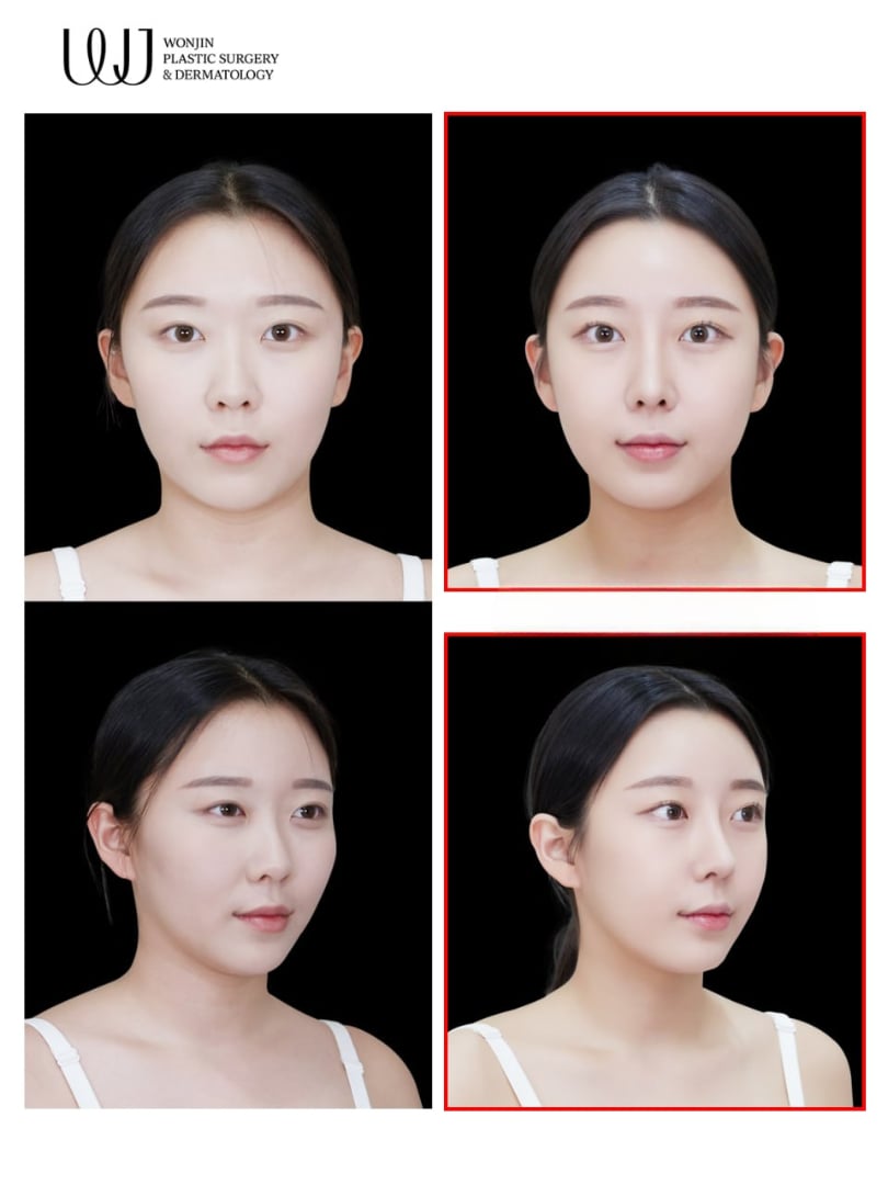 Facial contouring — before and after
