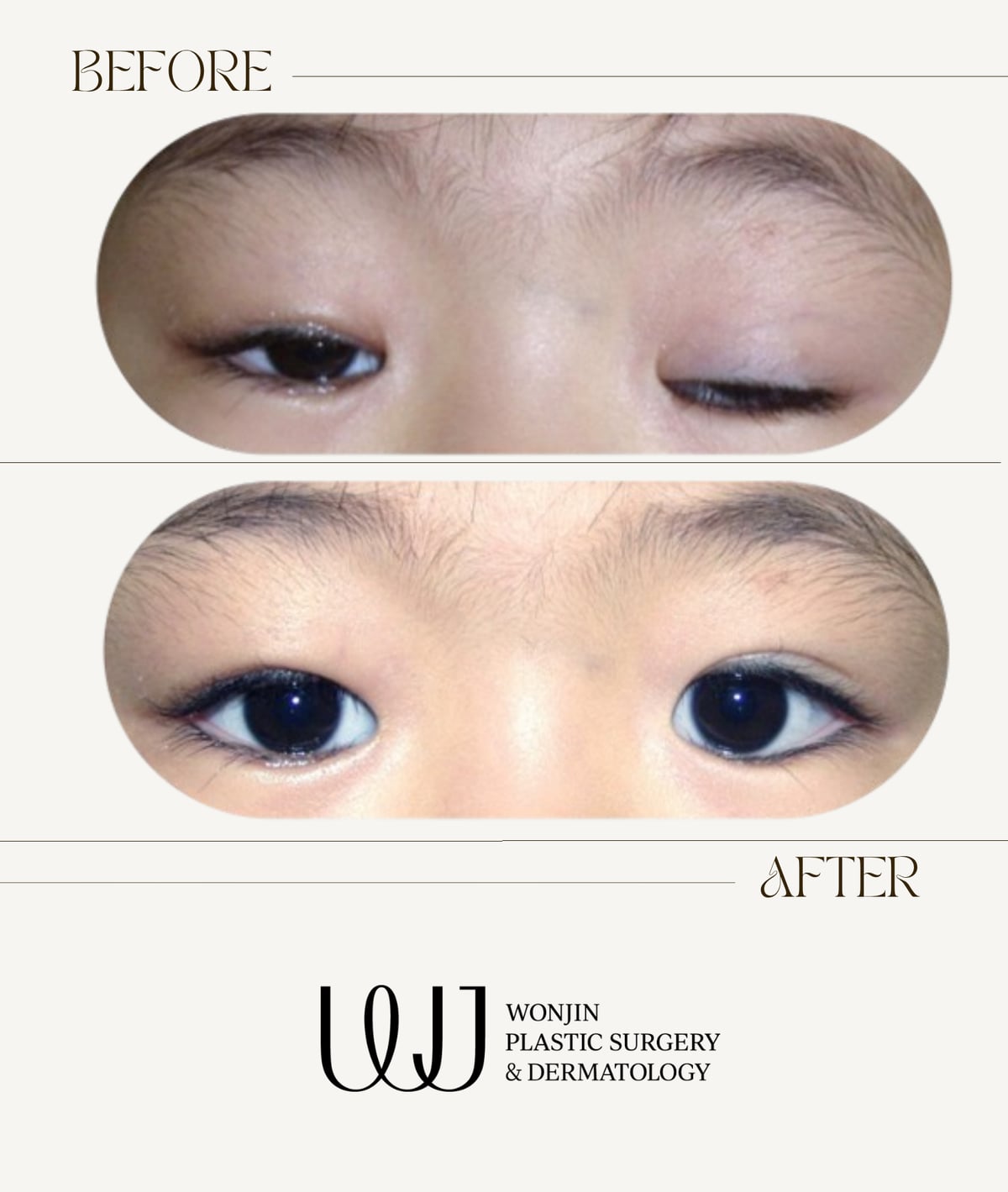 Double-eyelid & eye surgery — before and after