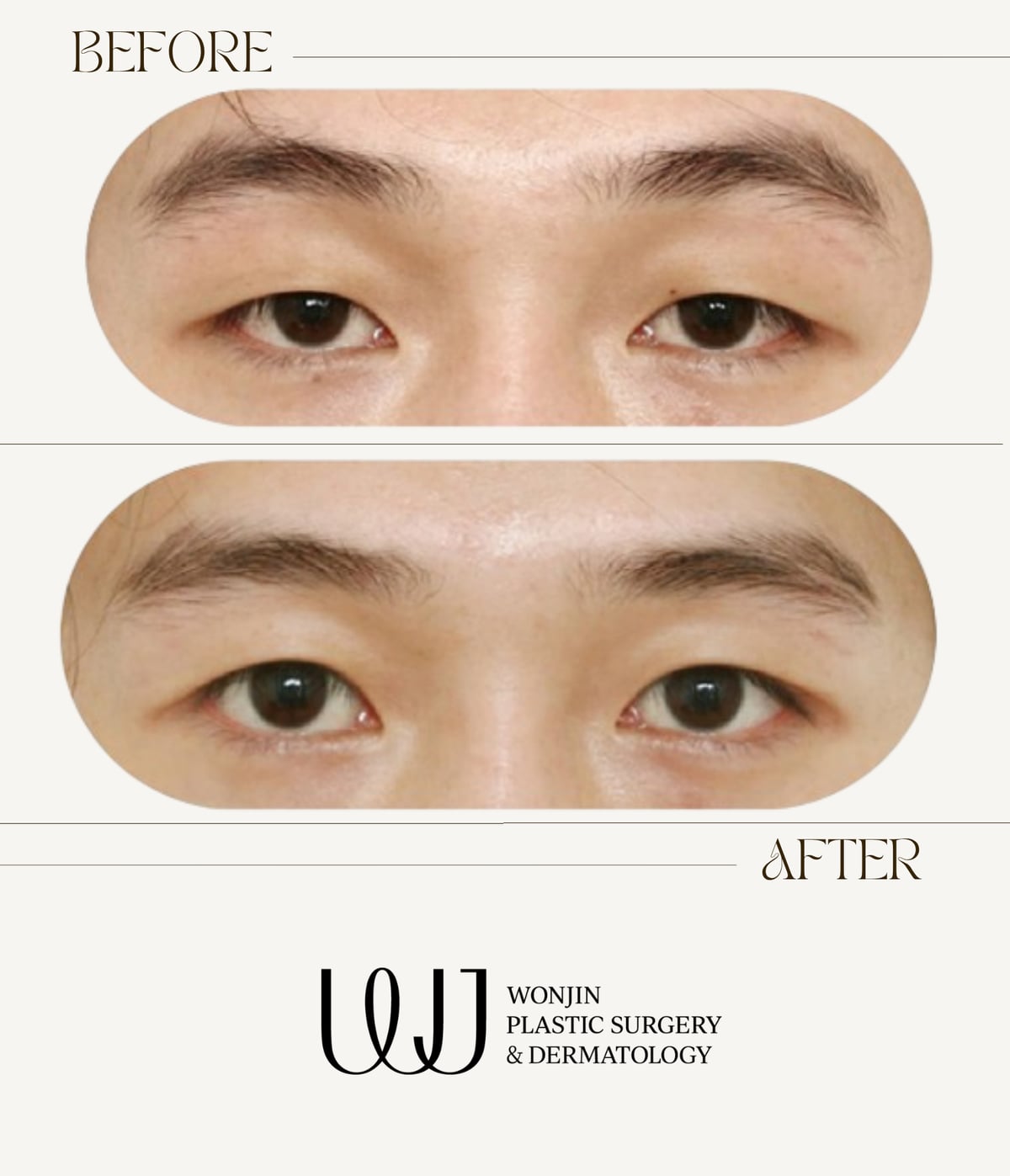 Double-eyelid & eye surgery — before and after