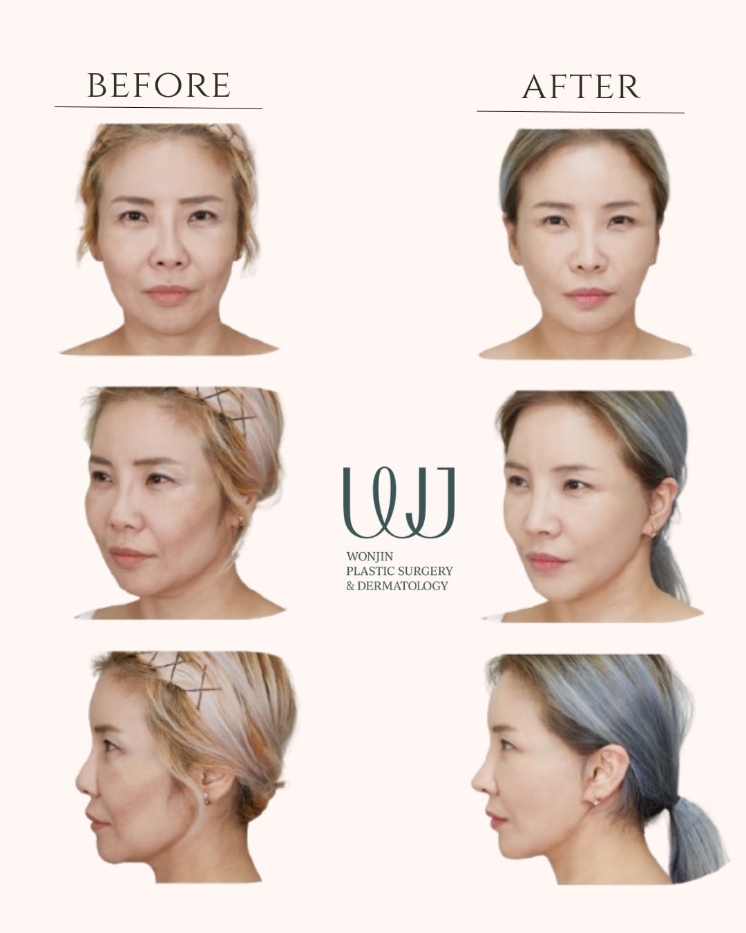 Face & neck lift — before and after