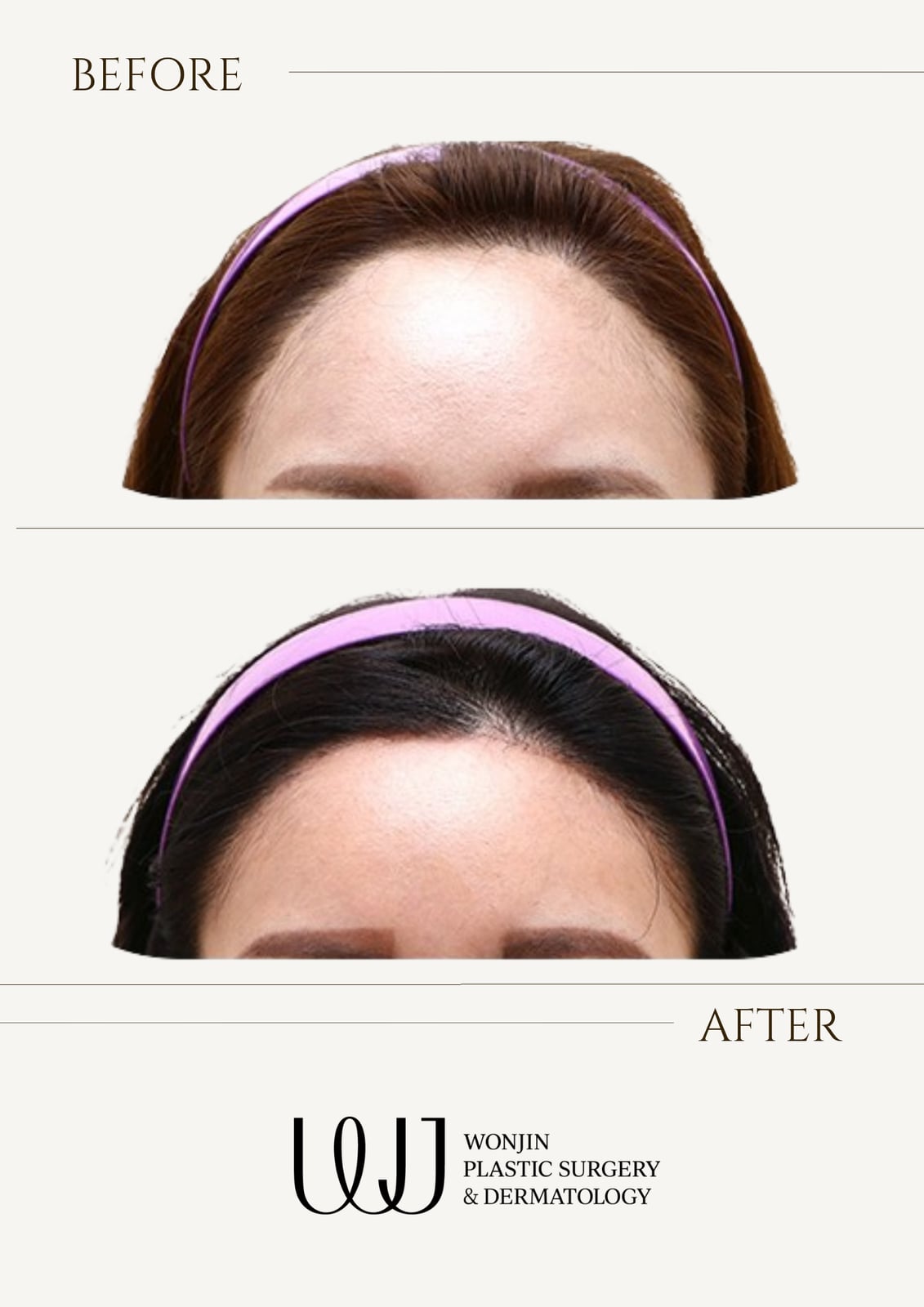 Forehead reduction — before and after