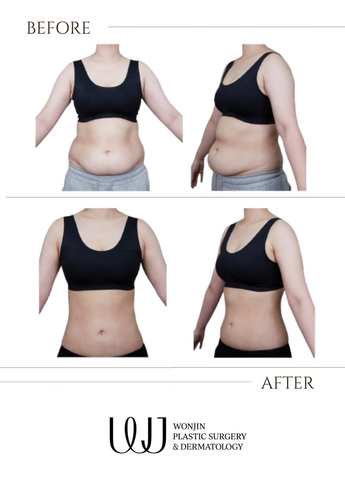 Liposuction & body contouring — before and after