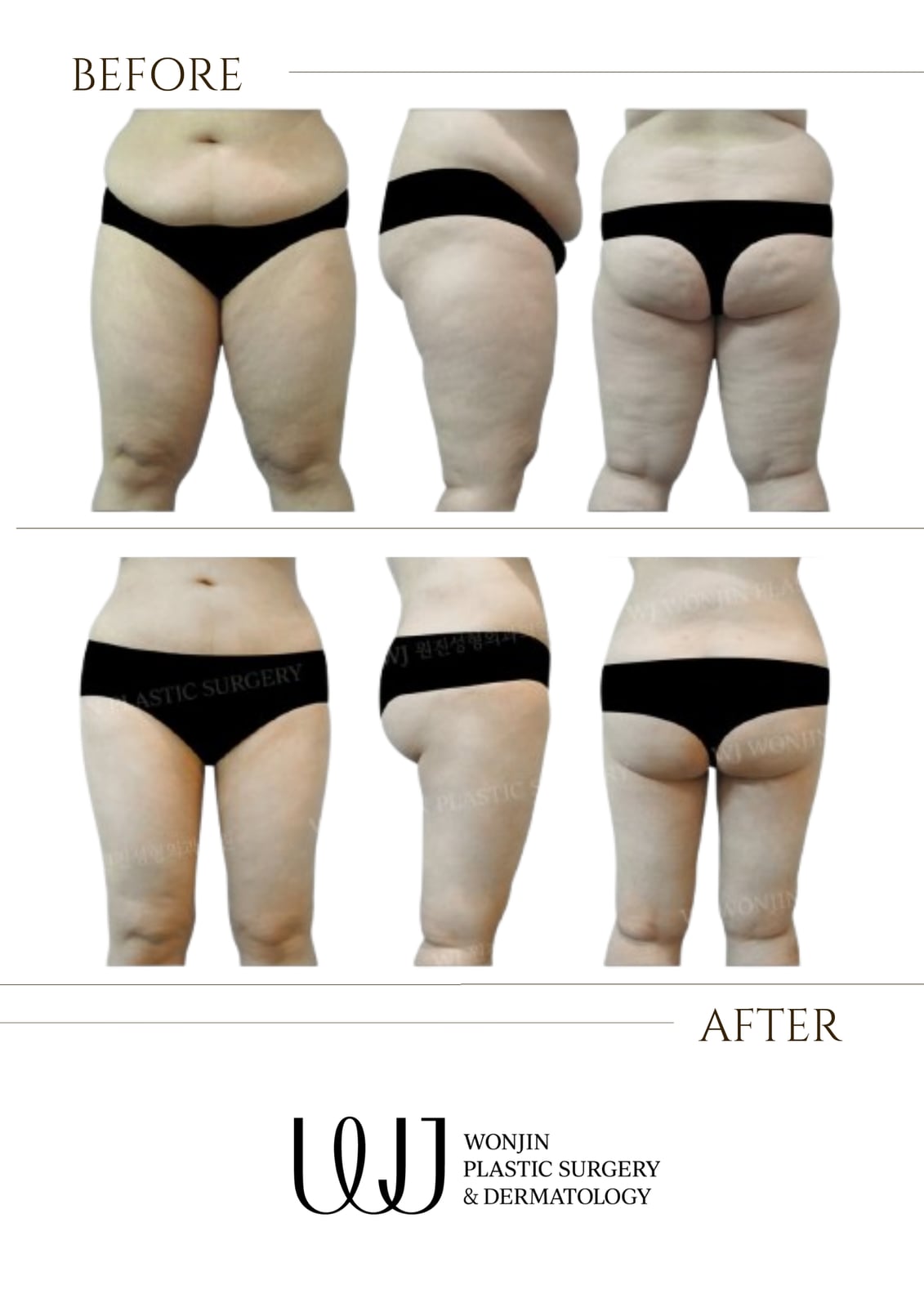 Liposuction & body contouring — before and after
