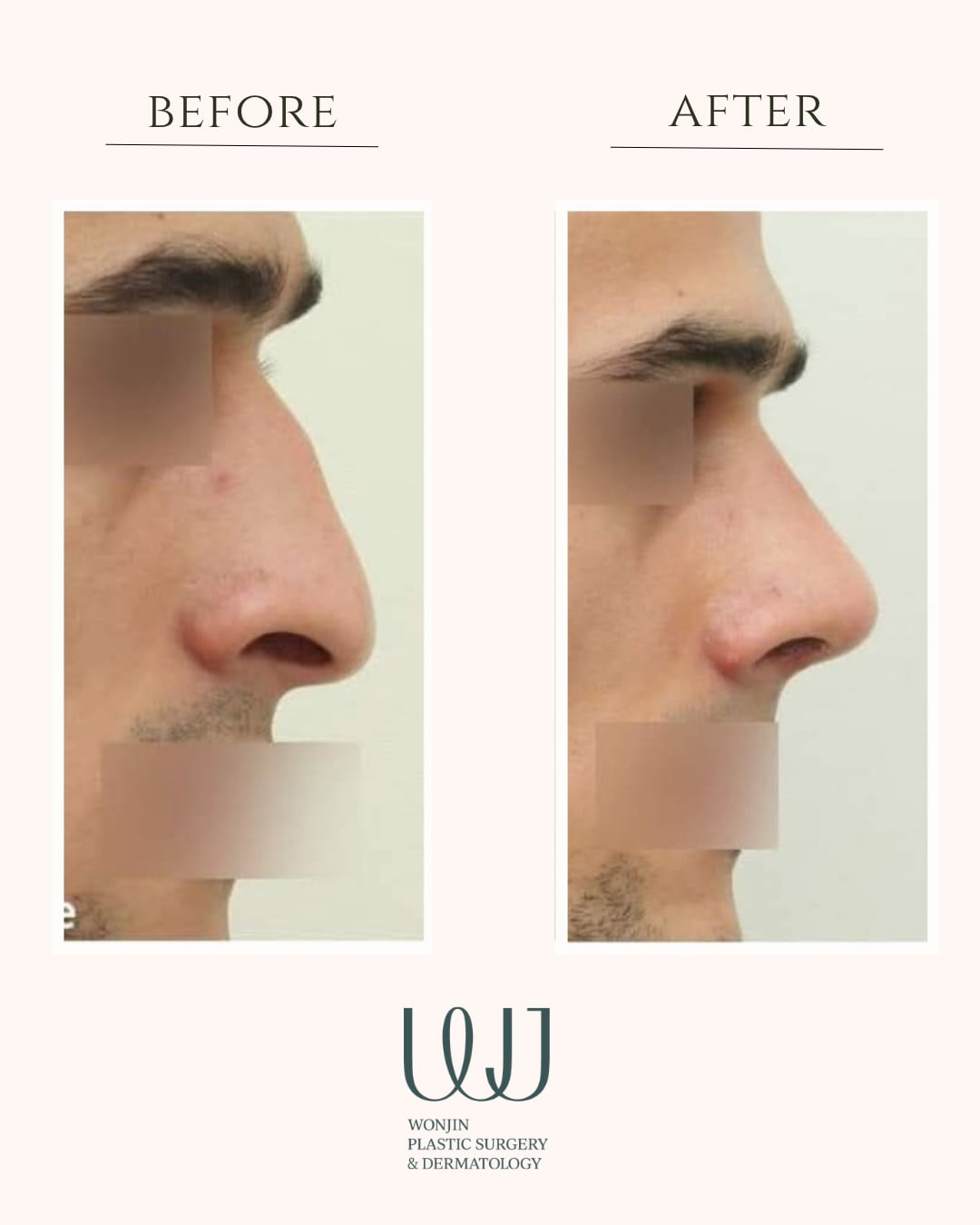 Rhinoplasty — before and after