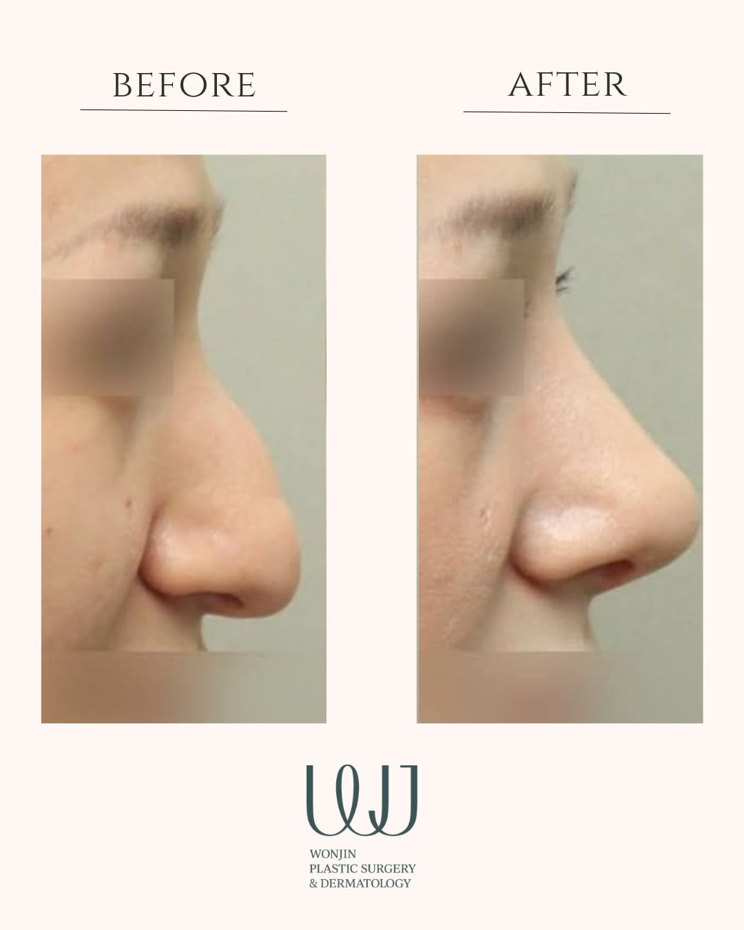 Rhinoplasty — before and after
