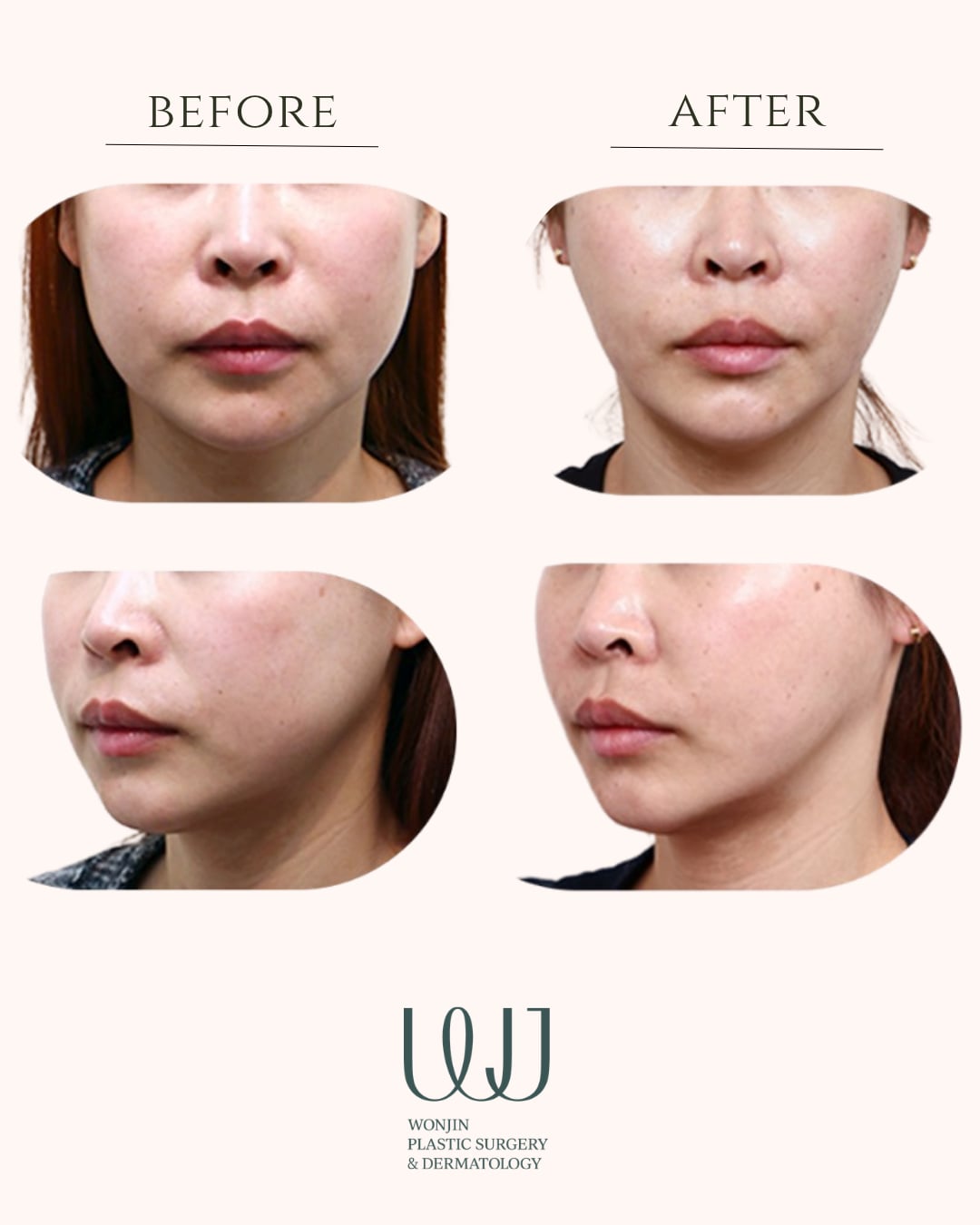 Elasticum thread lift — before and after