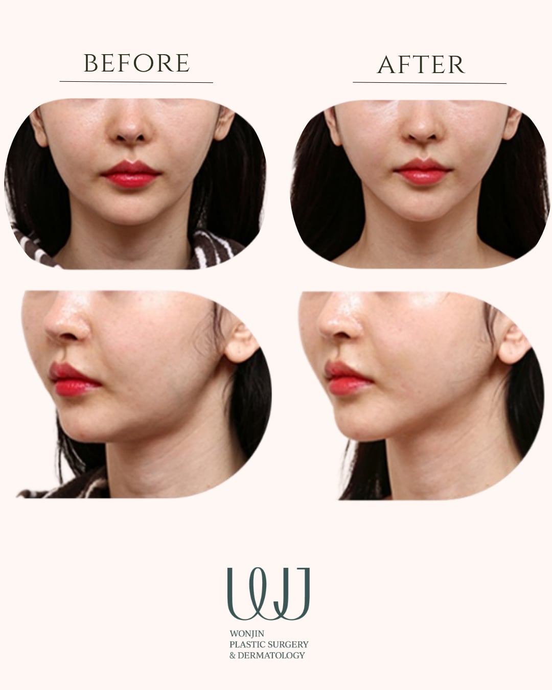 Elasticum thread lift — before and after