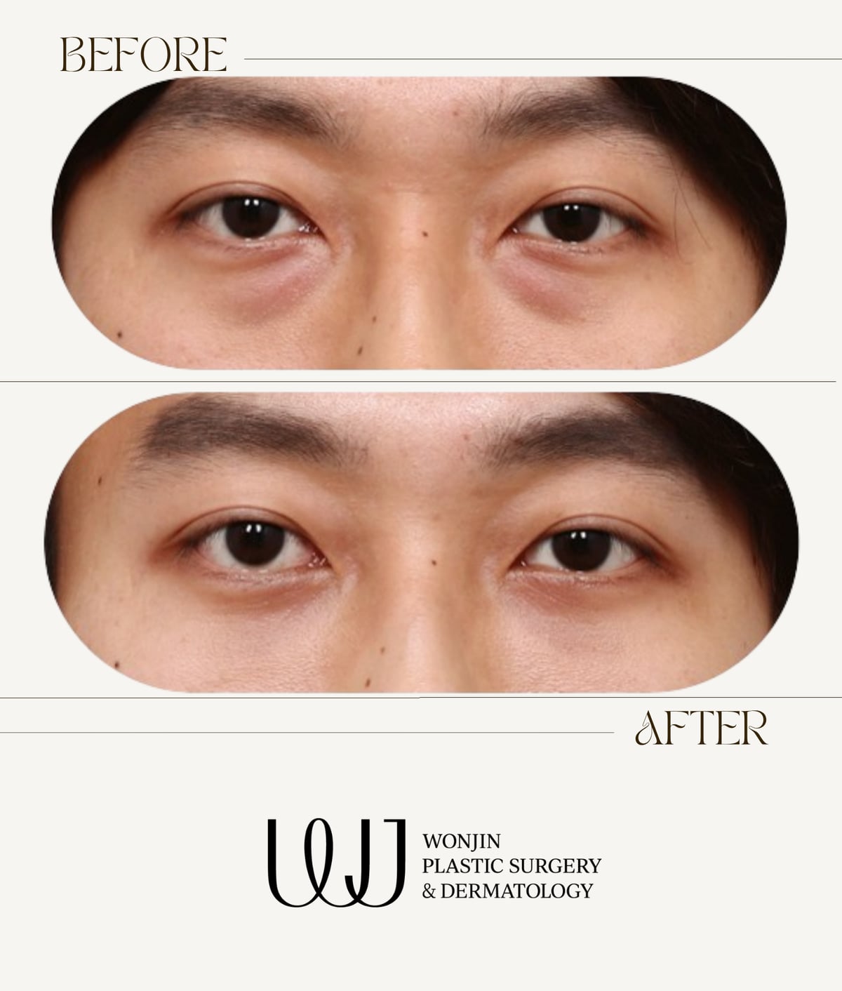 Under-eye fat repositioning — before and after